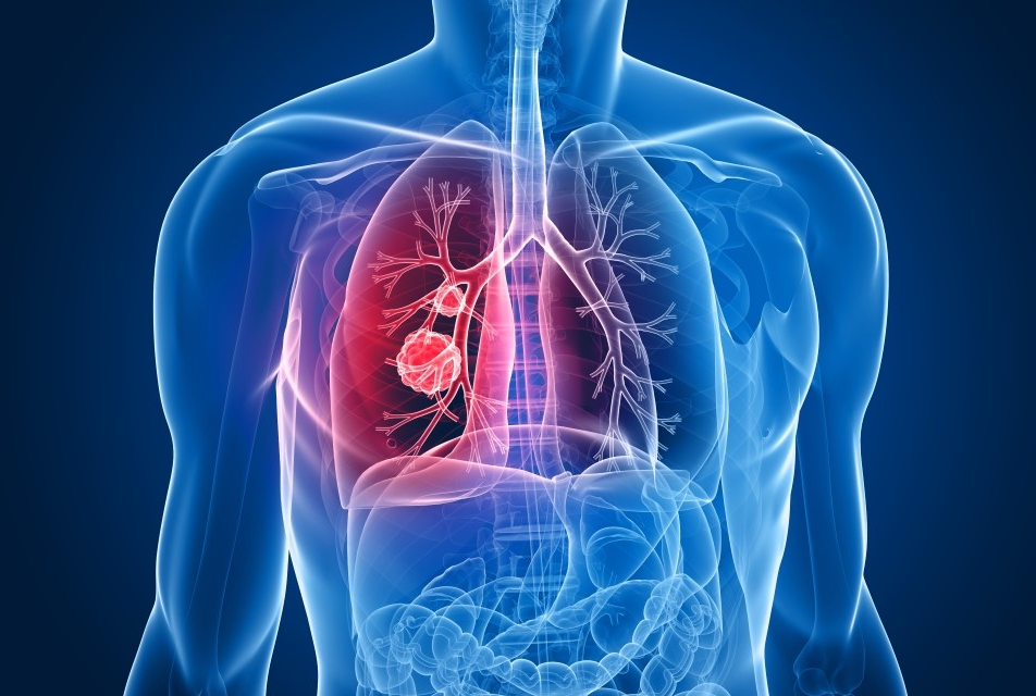 gene signature non-small cell lung cancer