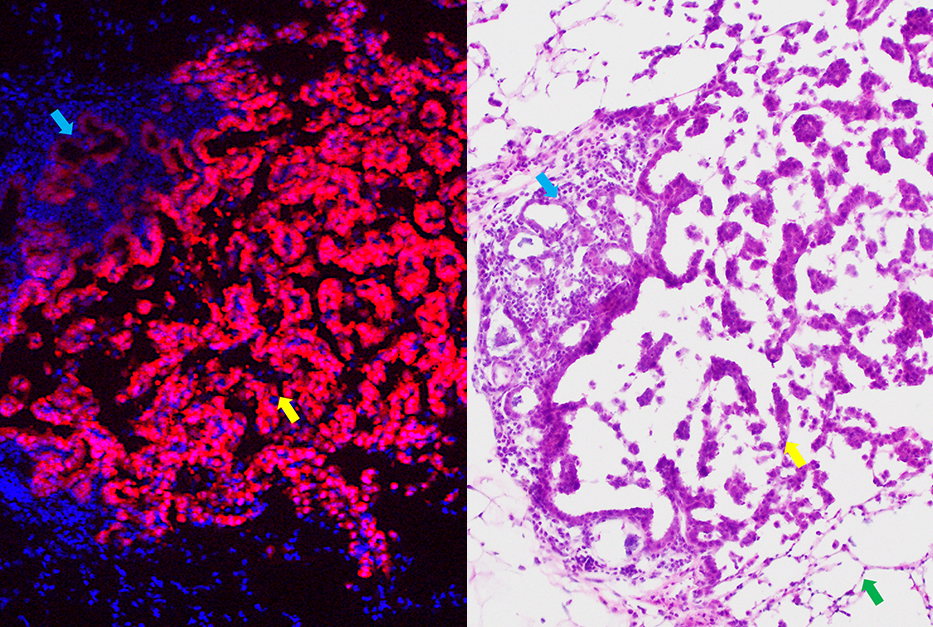 lung cancer model