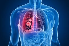 Gene Signature May Predict Response to Immunotherapy for Non-Small Cell Lung Cancer